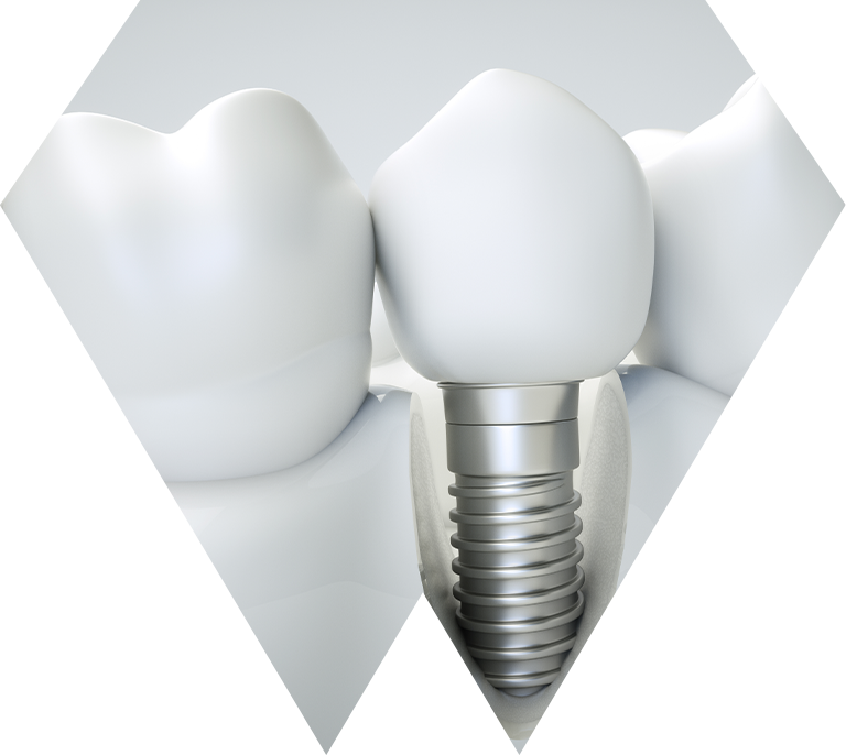 Dental Implant